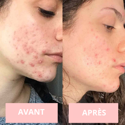 NOVASKIN APPAREIL DE THÉRAPIE VISAGE HAUTE FRÉQUENCE
