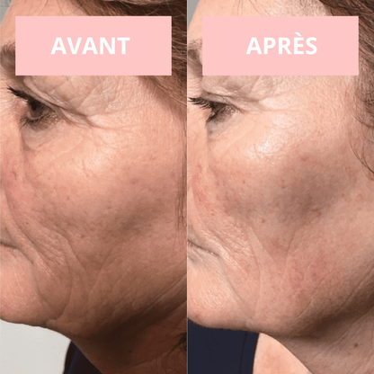 NOVASKIN APPAREIL DE THÉRAPIE VISAGE HAUTE FRÉQUENCE