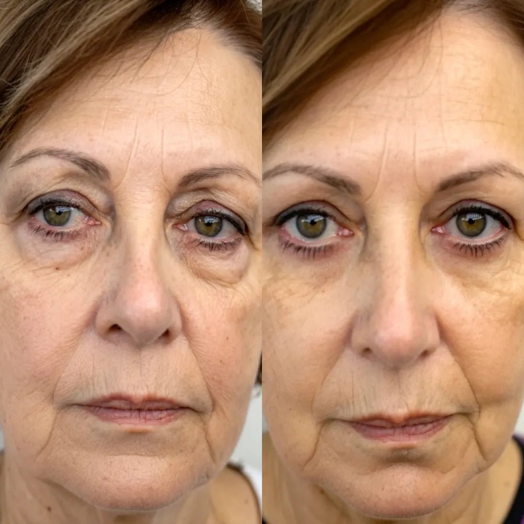 NOVASKIN LUNETTES À LUMIÈRE ROUGE POUR LE CONTOUR DES YEUX