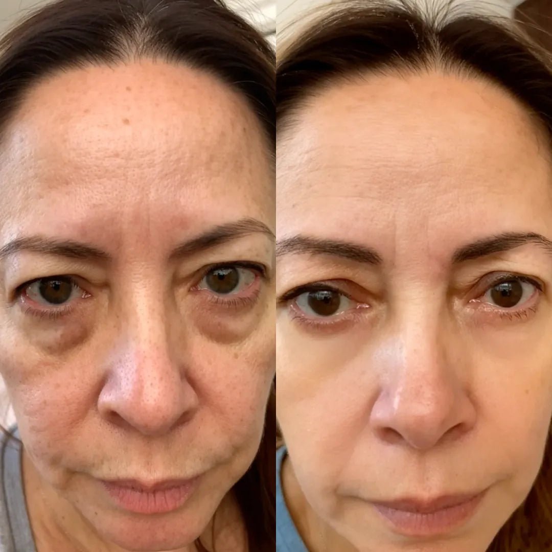NOVASKIN LUNETTES À LUMIÈRE ROUGE POUR LE CONTOUR DES YEUX